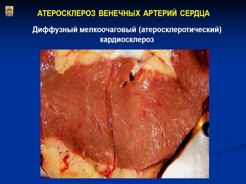 АТЕРОСКЛЕРОЗ ВЕНЕЧНЫХ АРТЕРИЙ СЕРДЦА Диффузный мелкоочаговый (атеросклеротический) кардиосклероз